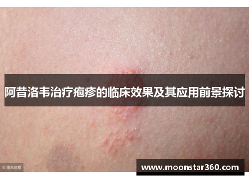 阿昔洛韦治疗疱疹的临床效果及其应用前景探讨